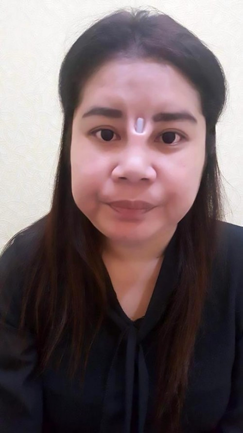 Cô gái bị phần sụn lòi ra ngoài sau khi phẫu thuật nâng mũi.