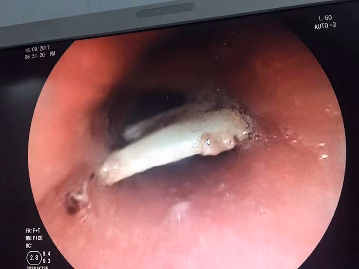 Hoc xuong thu lon, nam thanh nien bi rach thuc quan suyt chet