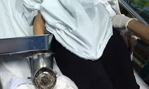 Mat nguyen ban tay vi chiec may xay thit