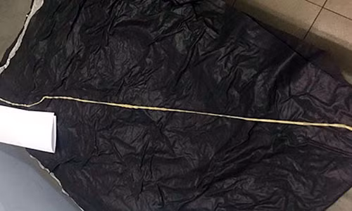 Phat hien san dai hon 1 m trong bung nu benh nhan