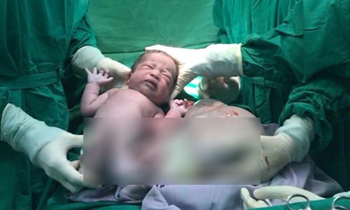 Bé gái song sinh còn nằm nguyên trong bọc điều.