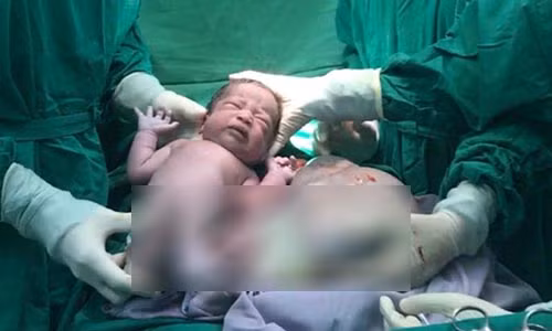 Bé gái song sinh còn nằm nguyên trong bọc điều.