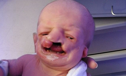 Ảnh chụp Zoey lúc mới sinh ra. Ảnh: Daily Mail