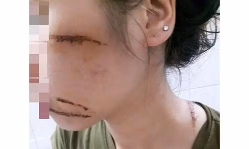 Hai Duong: Nu nhan vien spa bi nhom con do chem trong thuong