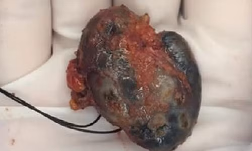 Nhiem muc tu hinh xam, nu benh nhan mac khoi u ky la