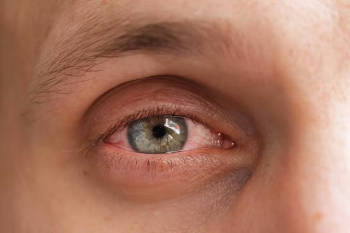 Giảm viêm kết mạc: Viêm kết mạc khiến mắt bị đỏ và sưng. Nếu bạn mắc phải tình trạng này, đặt một túi trà đen ấm và ướt trên mắt trong 5 phút, tiếp theo là một túi trà đã làm mát trong 2 phút. Chất tannin trong túi trà sẽ làm giảm sưng. Lặp lại vài lần trong ngày để loại bỏ vấn đề này.