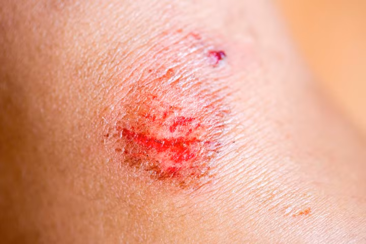 Điều trị vết thương: Chất tanin có trong trà đen hoạt động như chất làm se để ngăn ngừa chảy máu từ những vết thương hở. Nhẹ nhàng ấn một túi trà lọc đã ướt trên vùng bị ảnh hưởng để cầm máu và giảm bớt sự sưng tấy. Tuy nhiên, nếu bạn nhận thấy bất cứ dấu hiệu nhiễm trùng nào, hãy đến bệnh viện để được kiểm tra.