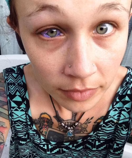 Dua doi xam trong mat, co gai tre bi chay dich tim, co nguy co mu-Hinh-2