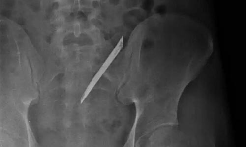 Lưỡi dao dài 12 cm qua hình chụp CT scan.