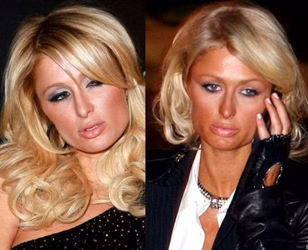 "Cùng chung số phận", Paris Hilton cũng khiến nhiều người phải sửng sốt khi lộ nước da đen "loang lổ"và đôi mắt kém đẹp của mình.