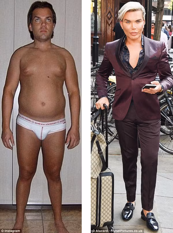 Bup be song suyt mat mui vi ham ho phau thuat tham my-Hinh-3