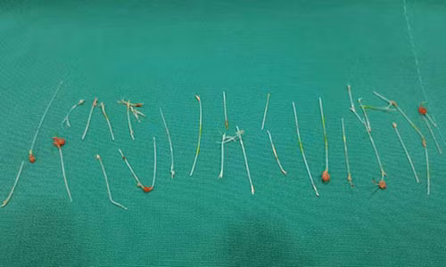 Gap gan 30 soi chi cho benh nhan sau khi nang mui bi hoai tu