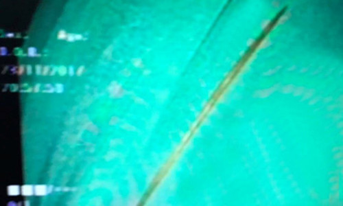 Chiếc tăm nhọn làm thủng tá tràng bệnh nhân. Ảnh: BSCC.