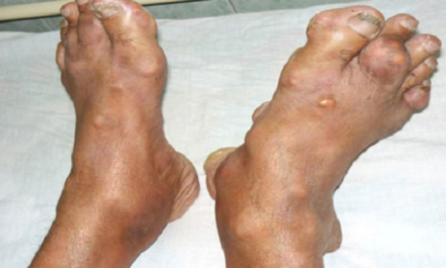 Bàn chân của anh N.H.M.(34 tuổi, ngụ quận Gò Vấp, TP.HCM)
