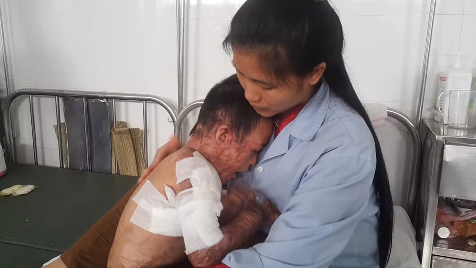 Bé Đức bị bỏng nặng và liên tục đòi mẹ được gặp bố và em.