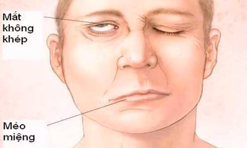 Thời tiết chuyển lạnh: Thức đêm nhiều cẩn thận kẻo méo miệng, lệch mặt Thoi tiet chuyen lanh: Thuc dem nhieu can than keo meo mieng, lech mat