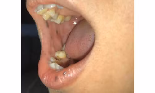 Các nốt sẫm màu mọc trong miệng, môi bệnh nhân.