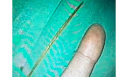 Dị vật được gắp ra từ tá tràng bệnh nhân.