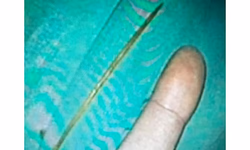 Dị vật được gắp ra từ tá tràng bệnh nhân.