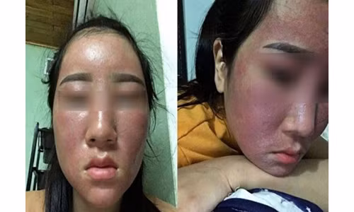 Nhiều chị em tin dùng những loại mỹ phẩm rẻ tiền để rồi nhận hậu quả khôn lường. Nhiều chị em tin dùng những loại mỹ phẩm rẻ tiền để rồi nhận hậu quả khôn lường.