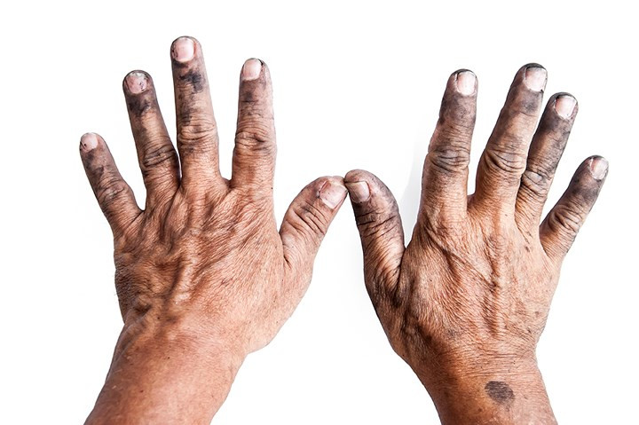 Bàn tay và móng tay bẩn. Hãy dùng kem dưỡng da và rửa tay bằng xà phòng thường xuyên.