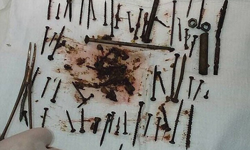 Các đồ vật được lấy từ dạ dày của bà Nina hầu như đã bị han gỉ.