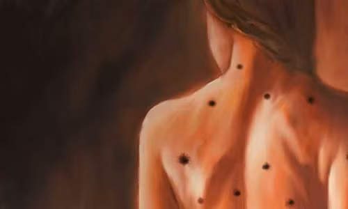 Not ruoi – dau hieu bao ung thu ban can biet