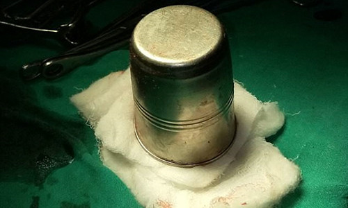 Chiếc cốc được lấy ra khỏi cơ thể bệnh nhân sau ca phẫu thuật. Ảnh: Daily Mail.