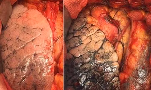 Moi nguoi chi 2,7 trieu moi nam de "mua" benh ung thu