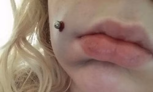 Tao lum dong tien, co gai bi chay mau 4 ngay do nhiem trung nang