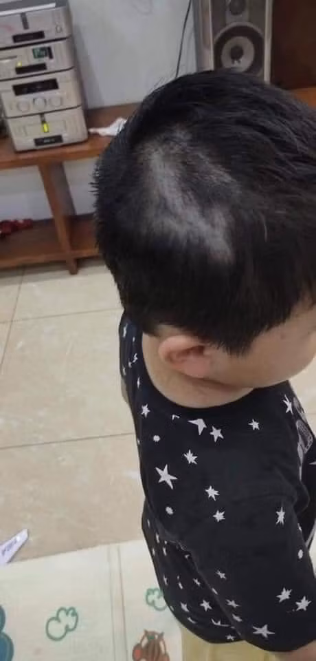 Được biết, cậu bé này đã tự soi gương "tự xử" thì mái tóc của mình và mất đi một mảng tóc ở bên phải. Khi bố mẹ phát hiện ra thì sự đã rồi. Ảnh: Trúc Quỳnh