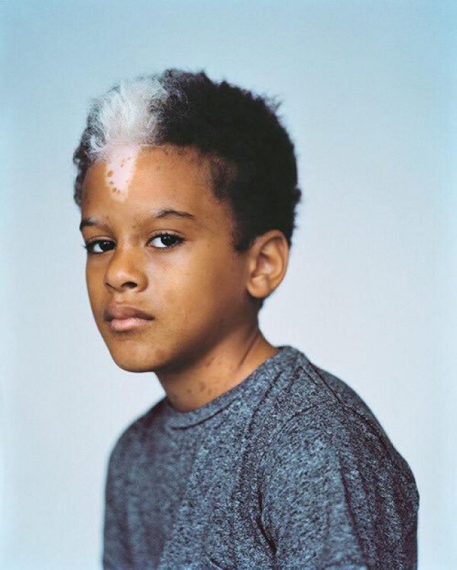  2. Piebaldism Bạn đừng quá ngạc nhiên nếu nhìn thấy 1 người có mảng tóc kèm da đầu màu trắng từ khi được sinh ra, bởi nhiều khả năng họ mắc hội chứng di truyền hiếm gặp Piebaldism. Được biết, căn nguyên của hiện tượng này chính là sự thiếu hụt của 1 loại tế bào có tên gọi melanocytes (tế bào bạch cầu) trong cơ thể. 