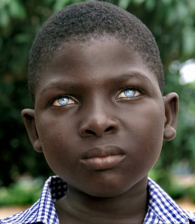  6. Bạch cầu mắt Hay còn gọi là bạch tạng mắt, đây là một hội chứng di truyền hiếm, khi mà chỉ có các hạt sắc tố ở giác mạc bị biến mất, thay vì cả cơ thể như ở bệnh bạch tạng toàn phần mà chúng ta thường thấy. Nếu bắt gặp một người sở hữu cặp mắt màu xanh dương hoặc xanh lá nhưng lại là thành viên của một gia đình có màu mắt đậm thì rất có thể họ đã mắc phải hội chứng này. 