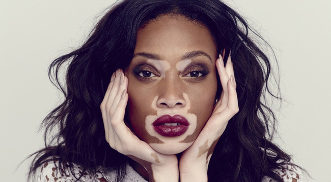 1. Bệnh bạch biến Bạch biến là hội chứng căn bệnh khiến da, tóc và thậm chí cả móng tay, móng chân mất màu. Hiện tại, không có phương pháp điều trị nhưng quá trình này có thể được làm chậm lại. Bệnh bạch biến không gây ảnh hưởng, phiền phức tới các hoạt động thường ngày nhưng lại ảnh hưởng nghiêm trọng đến vẻ bề ngoài của người bệnh.