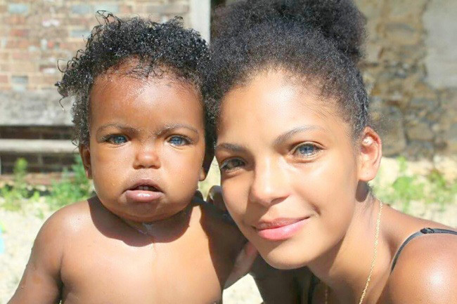 4. Hội chứng Waardenburg Hội chứng Waardenburg là một đột biến gene hiếm gặp khiến một người có màu mắt xanh đồng thời bị điếc bẩm sinh và những dị tật khác nữa. 