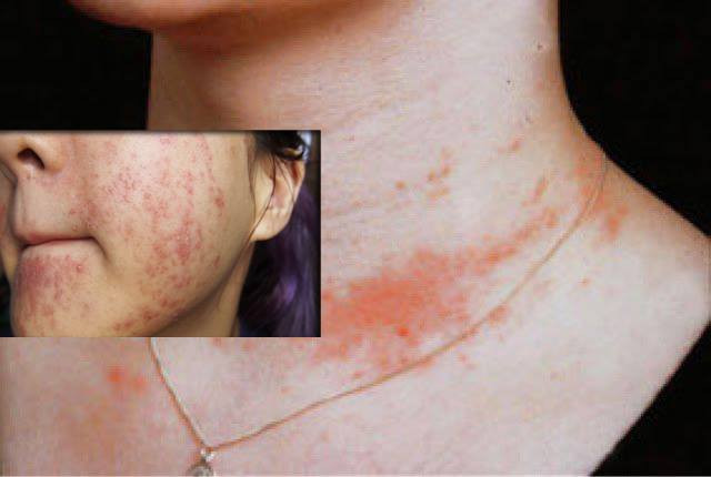 Nó cũng gây ra các vấn đề cho thai nhi như dị dạng, tăng nguy cơ sẩy thai, giảm kích thước của trẻ khi sinh.