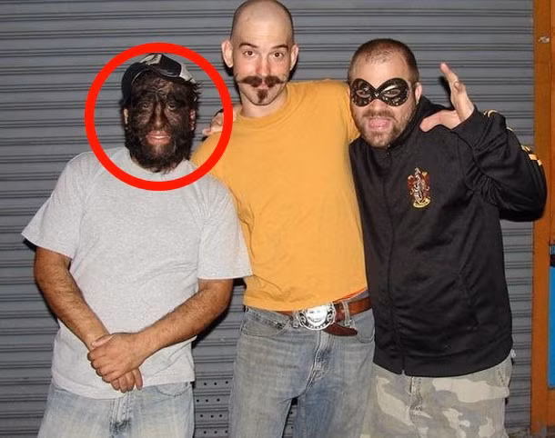 Người sói Jesus Aceves, Jesus được cho là người sói nổi tiếng nhất trên thế giới. Anh đến từ một gia đình nông thôn ở Mexico, một gia đình có tới 24 thành viên mắc phải căn bệnh nhiều lông hiếm có này. Đại gia đình của Jesus đã thoát nghèo nhờ tham gia một đoàn xiếc và đi khắp thế giới để quảng bá sự đột biến của mình.