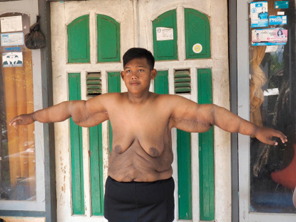 Nhận được trái ngọt sau nỗ lực hết mình song cậu bé nặng nhất thế giới lại đối diện với vấn đề da chảy xệ sau ép cân quá mức.