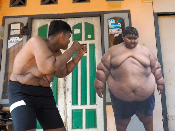 Cân nặng của Arya được bác sĩ gọi là một trong những trường hợp béo phì khó khăn nhất thế giới. Nếu không kiểm soát trọng lượng, nó có thể khiến cậu bé tử vong.