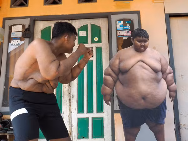 Cân nặng của Arya được bác sĩ gọi là một trong những trường hợp béo phì khó khăn nhất thế giới. Nếu không kiểm soát trọng lượng, nó có thể khiến cậu bé tử vong.