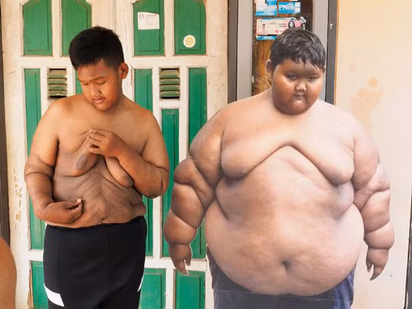 Để đảm bảo sức khỏe cho con trai, năm 2017, bố mẹ Arya quyết định đưa cậu đi gặp bác sĩ, thực hiện phẫu thuật thu nhỏ dạ dày.