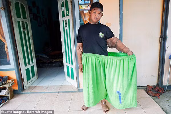 Để giúp Arya trở về cuộc sống bình thường, bác sĩ phẫu thuật thẩm mỹ Hardisiswo Soedjana cho biết họ sẽ tiến hành thủ thuật để nâng da ngực, loại bỏ phần da thừa trên bụng và cánh tay. Ảnh: Internet.