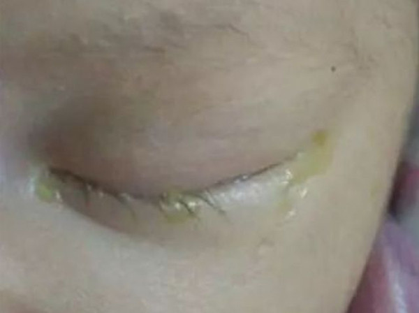 Tre lien tuc chay nuoc mat, me hoi han vi suyt khien con mac benh hiem