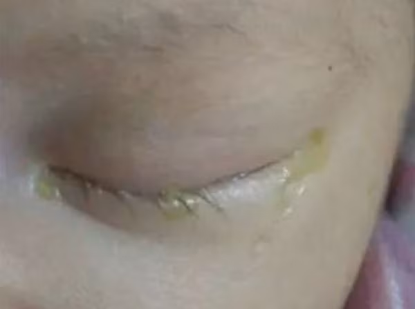 Tre lien tuc chay nuoc mat, me hoi han vi suyt khien con mac benh hiem