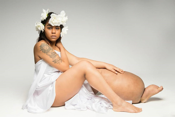 Ở thời điểm tồi tệ nhất, chân trái cô gái nặng tới 44kg, tổng trọng lượng cơ thể đạt 135kg. Hiện không có cách chữa trị phần chất lỏng dư thừa tích tụ ở chân. Nhằm giảm thiểu tình trạng sưng tấy, Mahogany thường xuyên tập vật lý trị liệu và xoa bóp dẫn lưu bạch huyết.