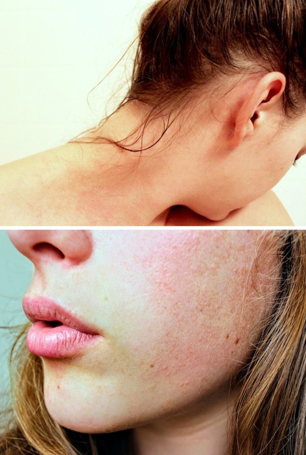 Tác hại để tóc ướt đi ngủ - Gây kích ứng da. Không chỉ ảnh hưởng đến sức khỏe, để tóc ướt đi ngủ còn không thân thiện với làn da. Khi ngủ, tóc ướt có thể xoã lên mặt. Sự kết hợp giữa tóc ướt và nhiệt độ cao trong phòng ngủ trở thành điều kiện lý tưởng cho sự phát triển của vi khuẩn gây kích ứng da .