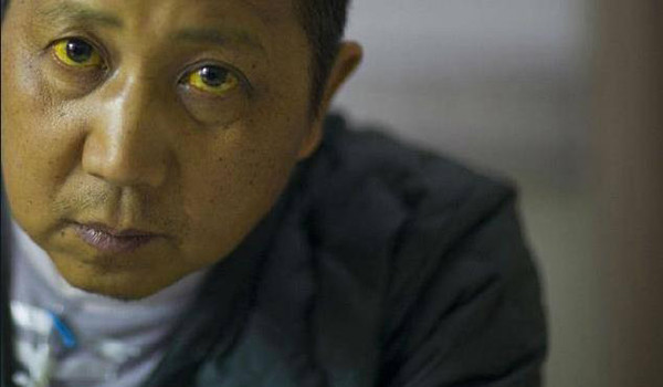 Dấu hiệu ung thư gan – vàng da. Vàng mắt, vàng da là một trong những dấu hiệu rõ ràng nhất khi gặp phải các vấn đề về gan.