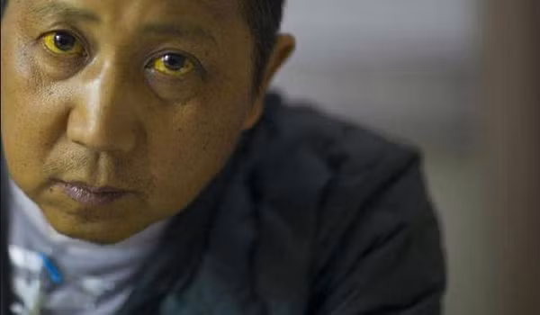 Dấu hiệu ung thư gan – vàng da. Vàng mắt, vàng da là một trong những dấu hiệu rõ ràng nhất khi gặp phải các vấn đề về gan.