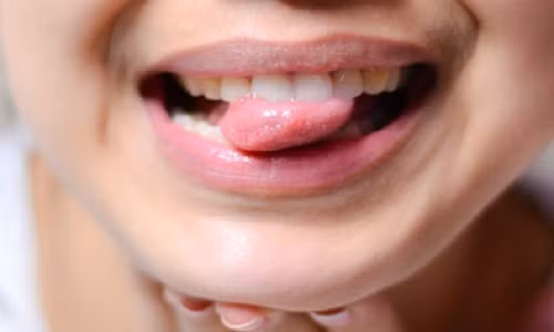 Tuong bi nhiet mieng giat minh phat hien bi ung thu luoi