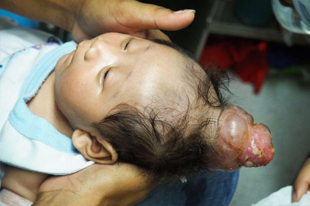 Chiếc "sừng" của bé trai thực chất là một khối u lành tính hiếm gặp